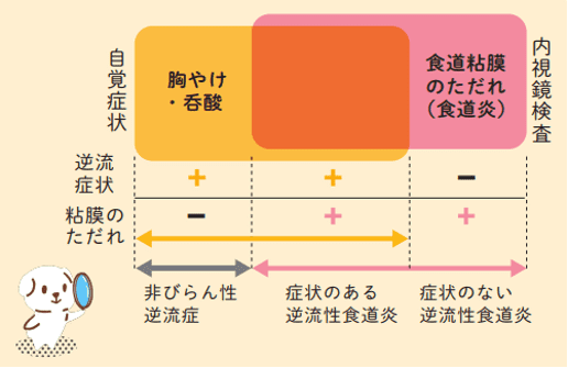 胃食道逆流症ガイド